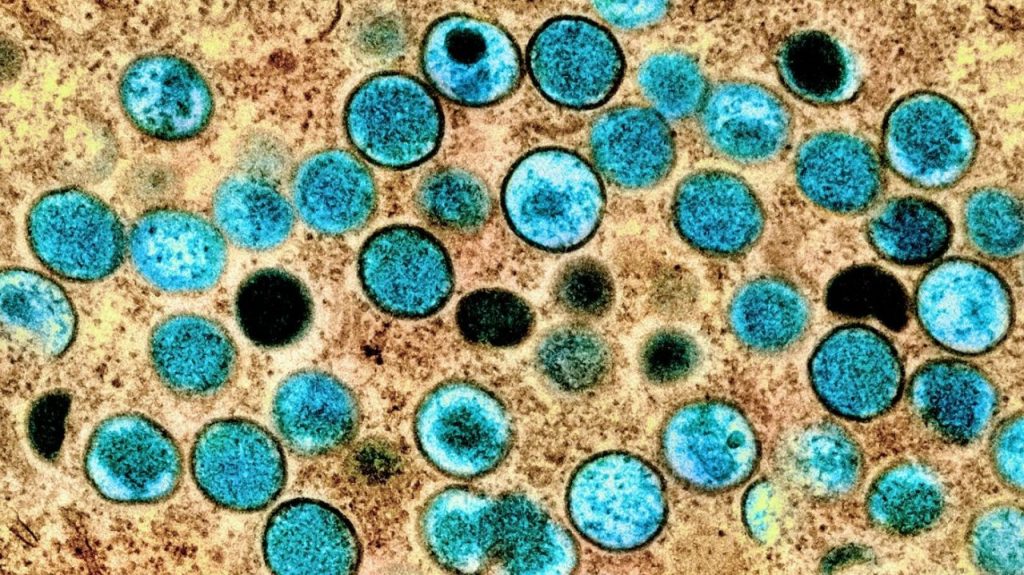 Black and Hispanic people bearing brunt of monkeypox cases: analysis Black and Hispanic people bearing brunt of monkeypox cases: analysis
