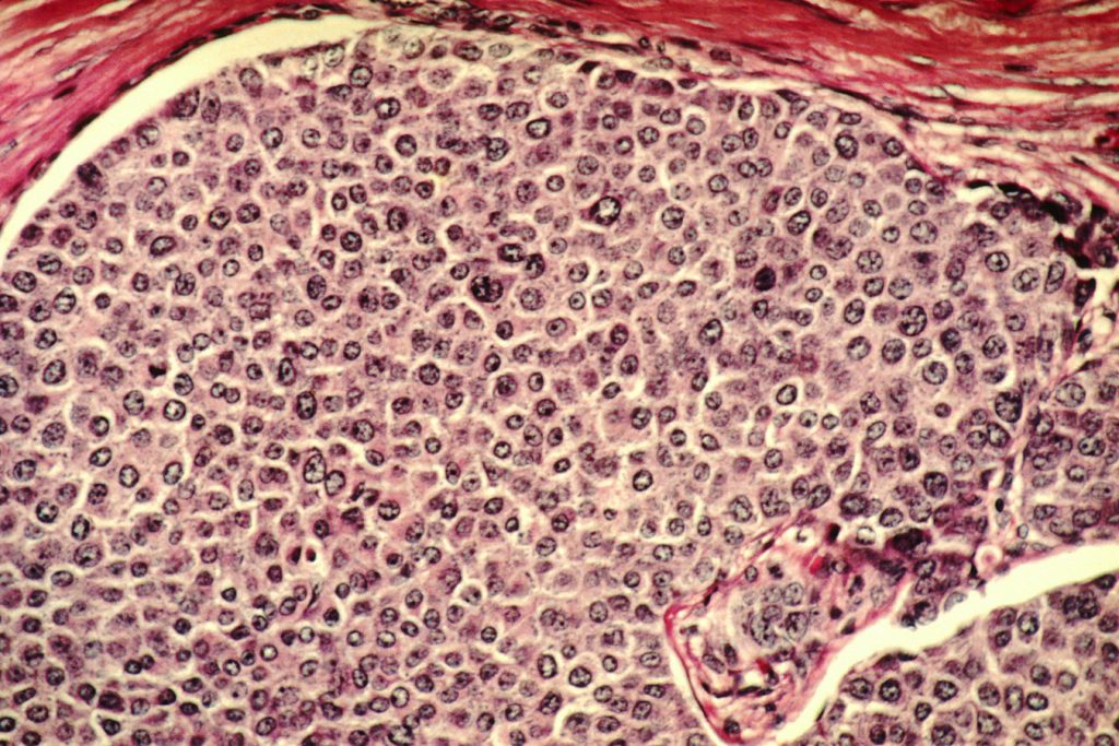 FDA approval of AstraZeneca drug is first for a new group of breast cancer patients – MedCity News FDA approval of AstraZeneca drug is first for a new group of breast cancer patients – MedCity News
